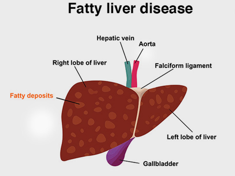 fatty liver